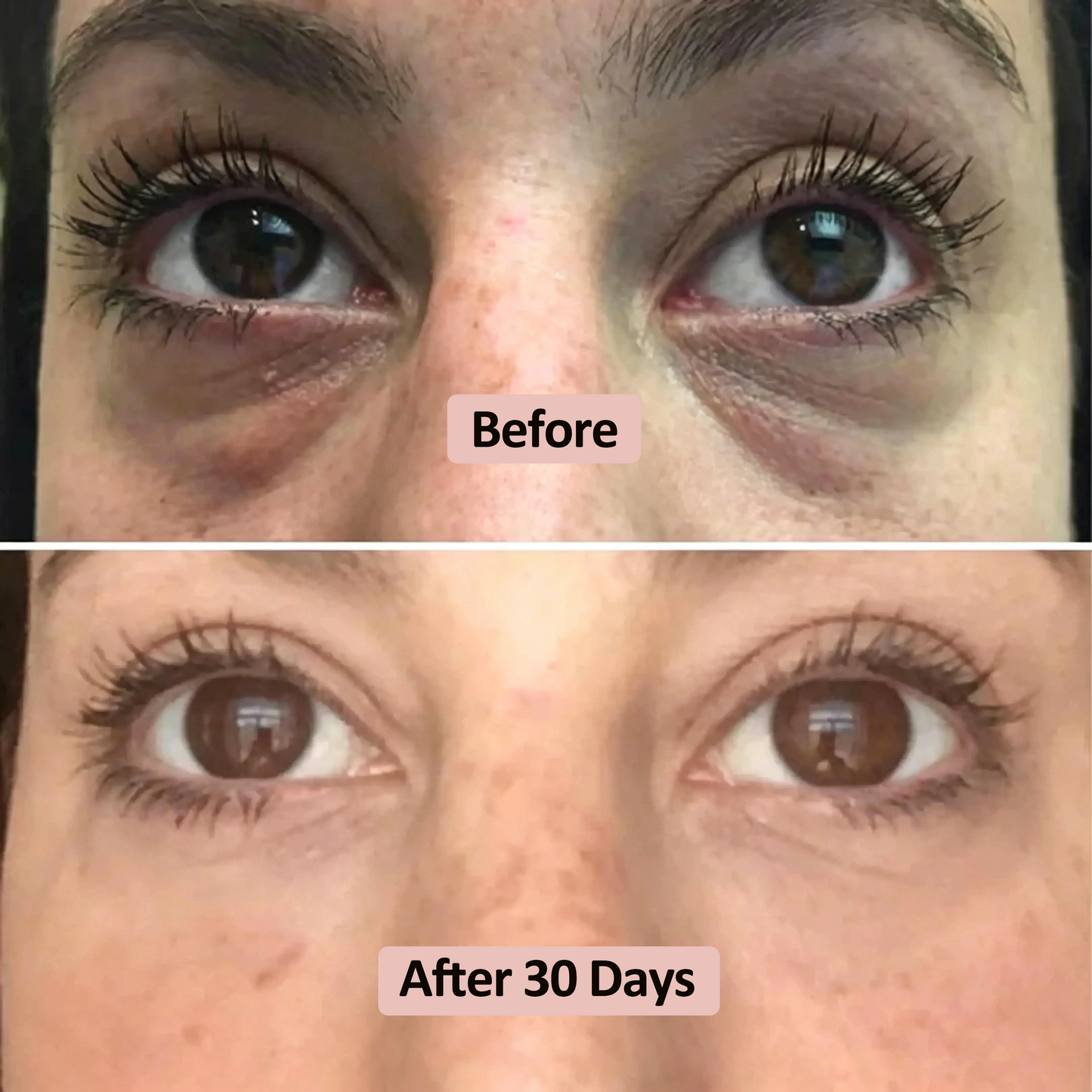 Microneedle Eye Patch
